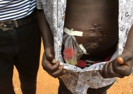Sirage ileostomoy bag